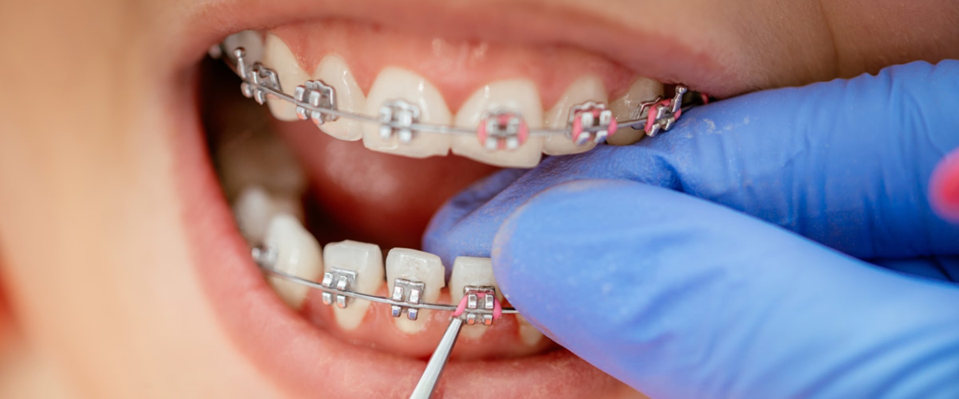Steps for Getting Orthodontic Treatment