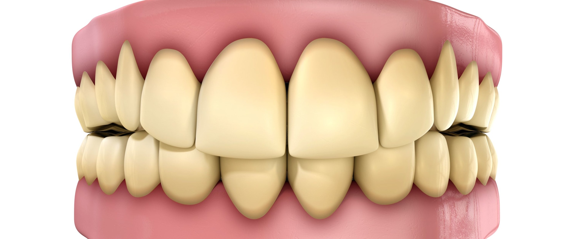 Understanding the Causes of Tooth Discoloration