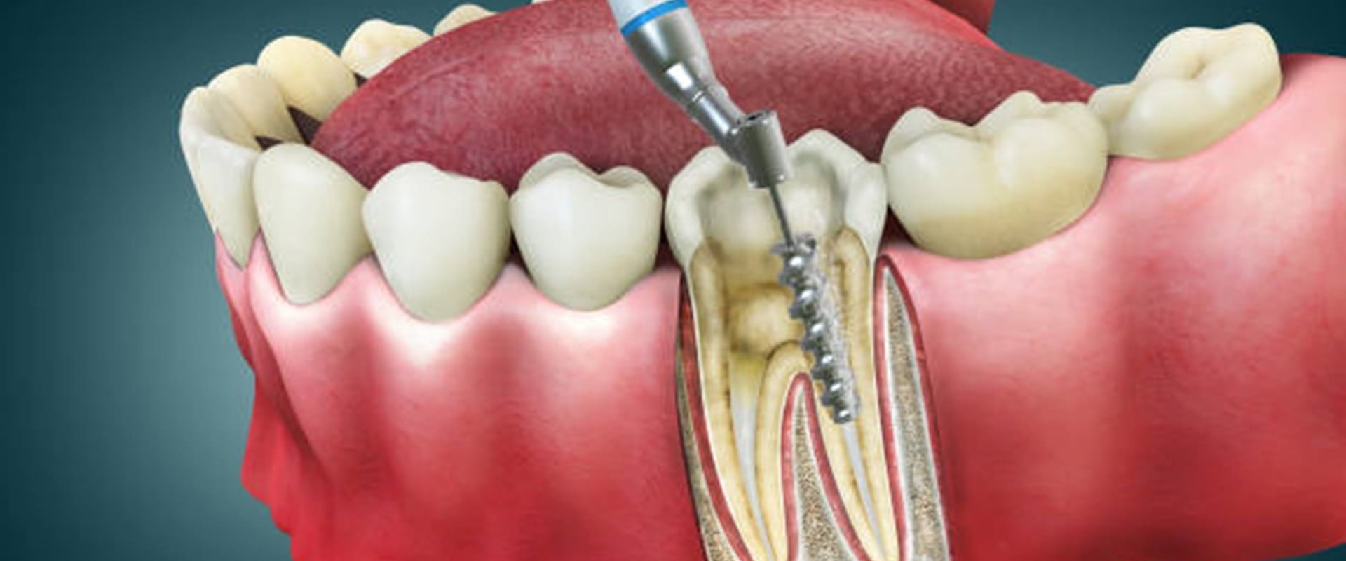 Aftercare for a Root Canal: Tips and Information for Affordable Dental Insurance Coverage