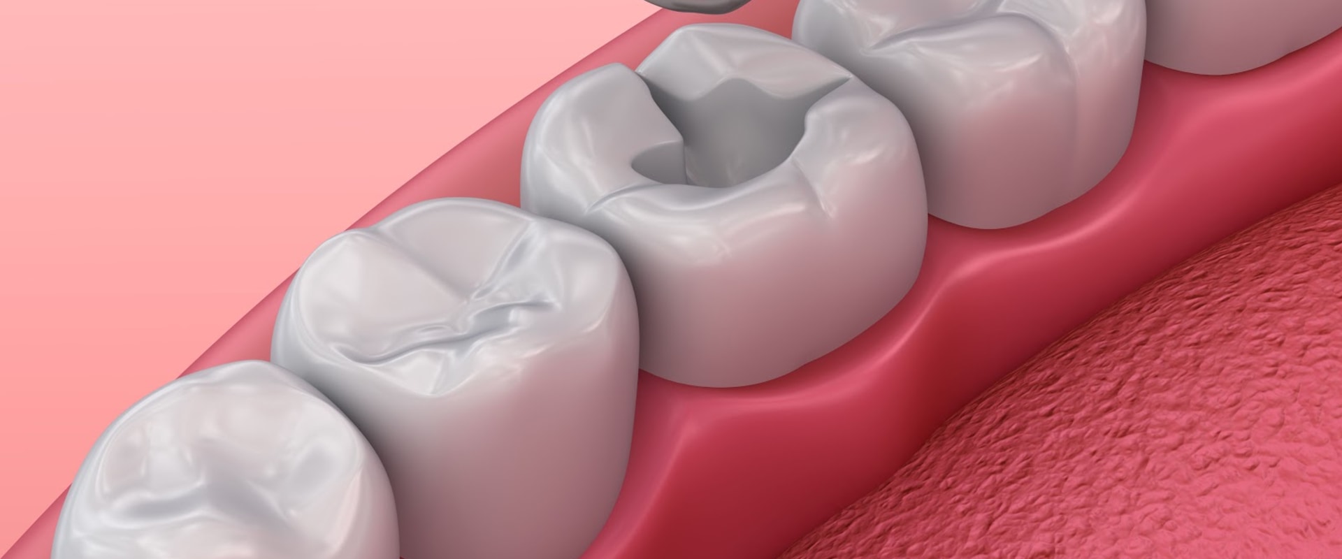Understanding the Different Types of Dental Fillings