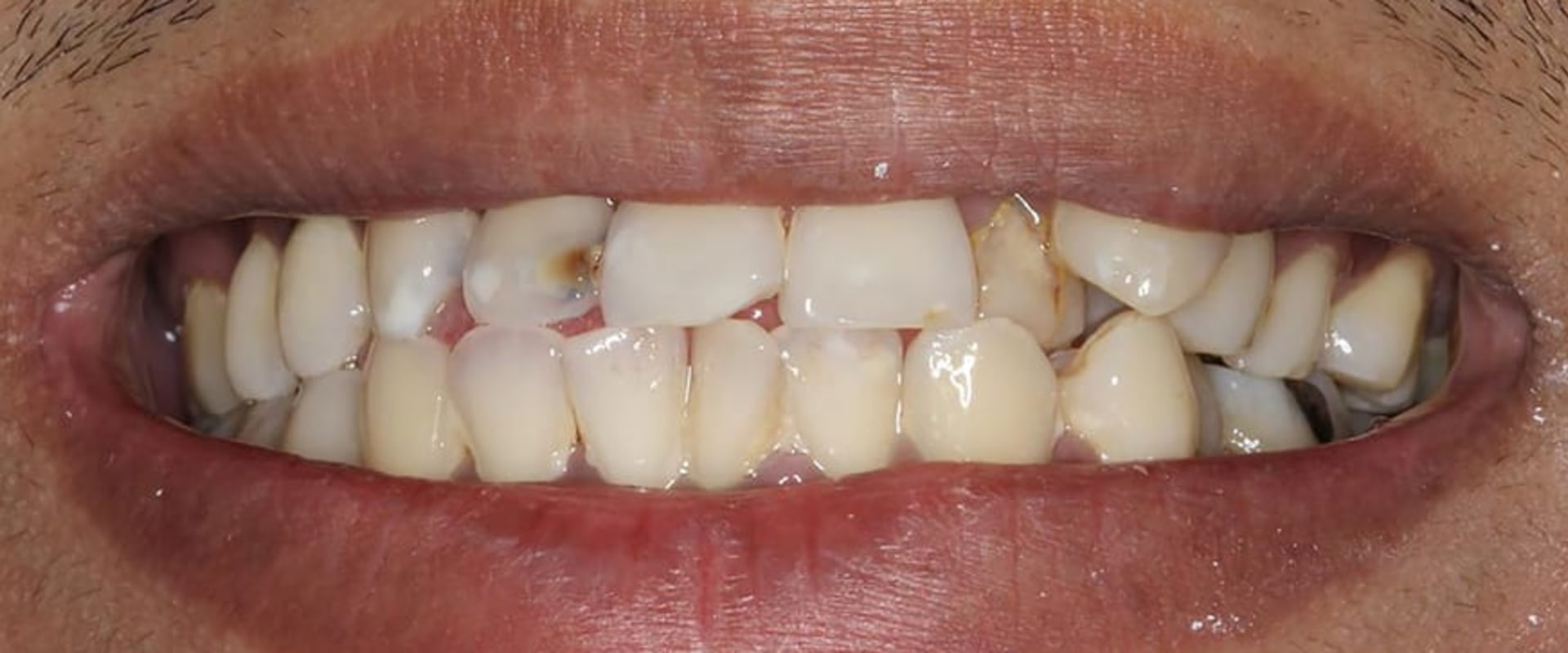 A Comprehensive Look at the Different Types of Dental Veneers
