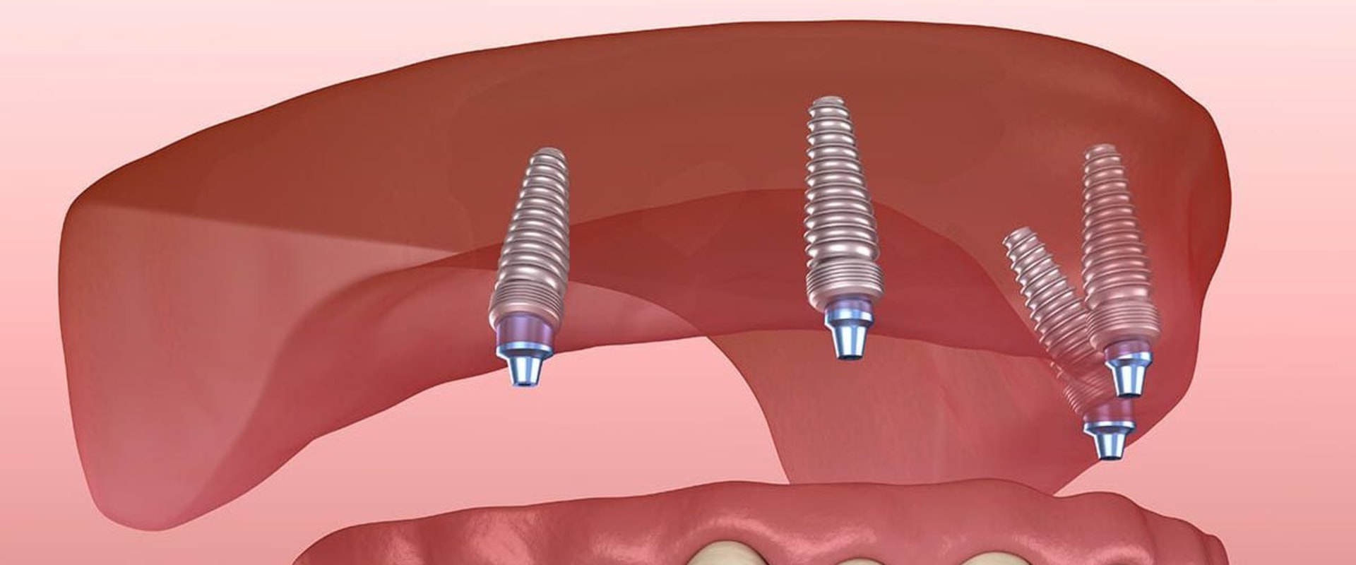 A Comprehensive Guide to Getting Affordable Dental Implants