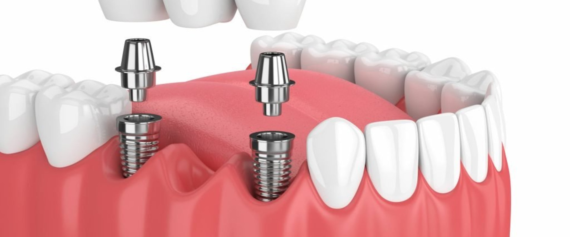 The Benefits of Dental Implants: Improving Your Oral Health and Saving Money