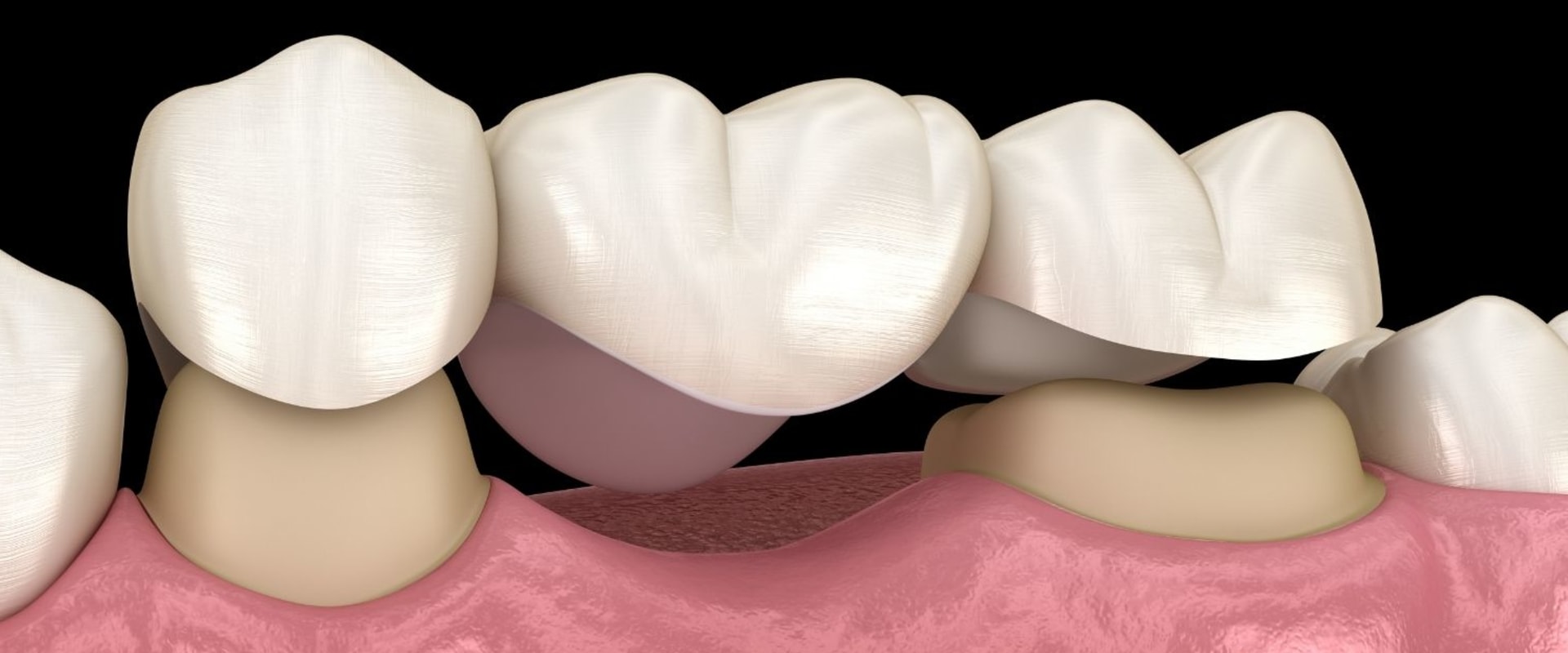 The Process for Getting a Dental Bridge: Everything You Need to Know