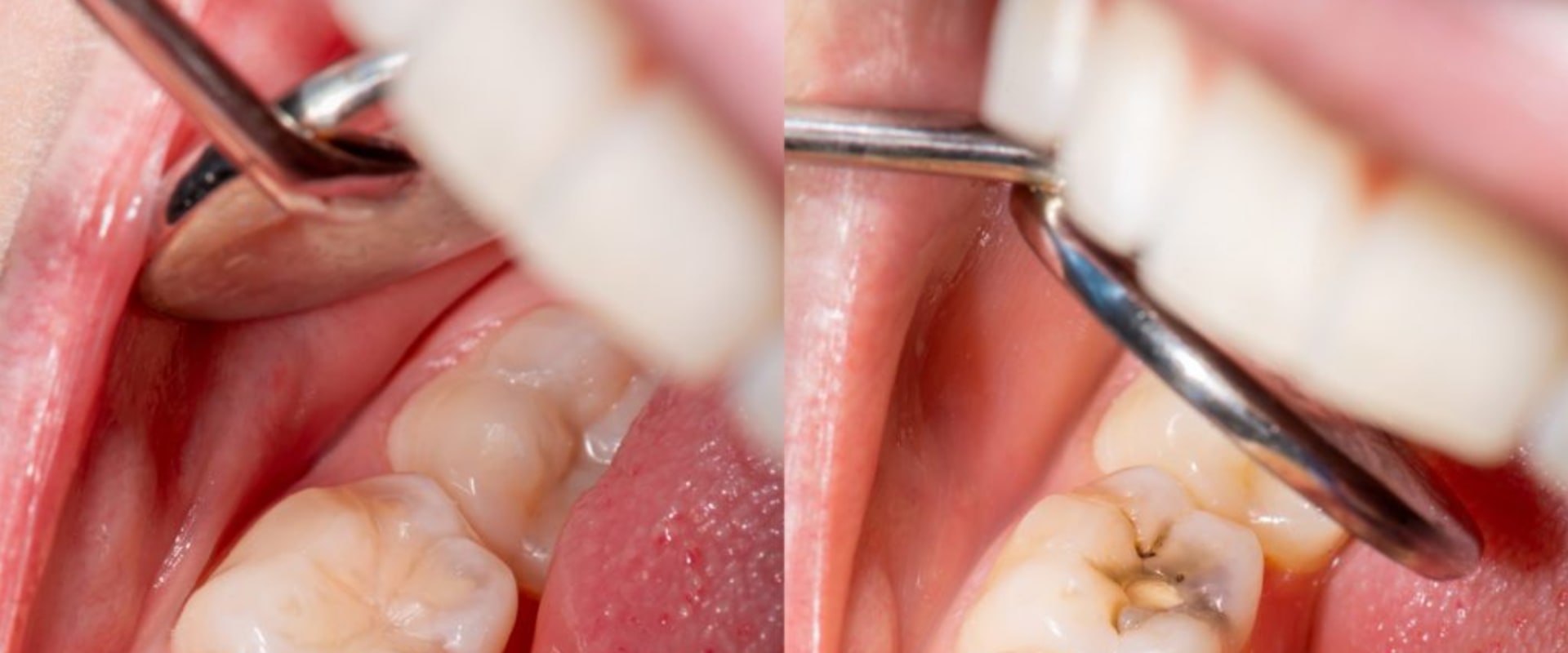 Care for Fillings: Everything You Need to Know