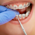 Steps for Getting Orthodontic Treatment