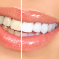 Caring for Teeth After Whitening: Tips and Tricks to Keep Your Smile Bright
