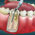 Aftercare for a Root Canal: Tips and Information for Affordable Dental Insurance Coverage