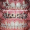 A Comprehensive Overview of Different Types of Orthodontic Treatments