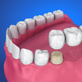 Maintenance for Dental Bridges: Keeping Your Smile and Wallet Healthy