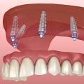 A Comprehensive Guide to Getting Affordable Dental Implants