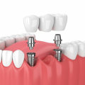 The Benefits of Dental Implants: Improving Your Oral Health and Saving Money