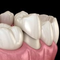 Different Types of Dental Crowns: A Comprehensive Guide