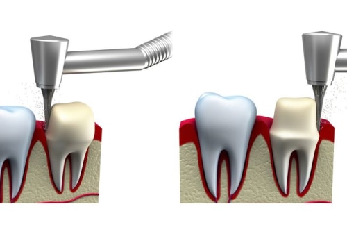 Steps to Getting a Dental Crown: What You Need to Know