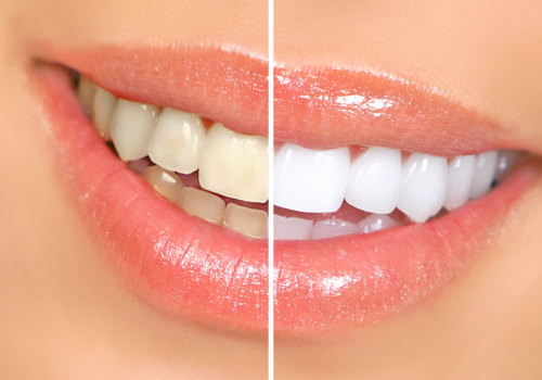 Caring for Teeth After Whitening: Tips and Tricks to Keep Your Smile Bright