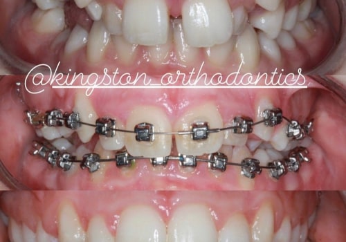 A Comprehensive Overview of Different Types of Orthodontic Treatments