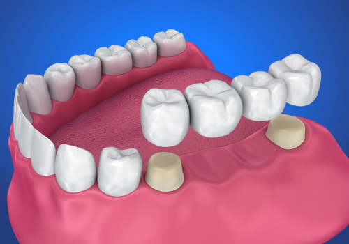 Maintenance for Dental Bridges: Keeping Your Smile and Wallet Healthy