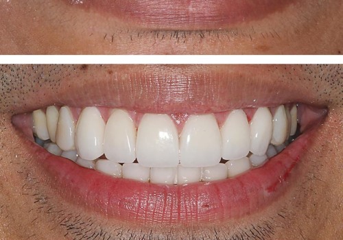 A Comprehensive Look at the Different Types of Dental Veneers