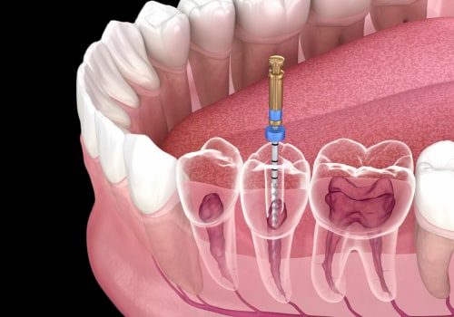 Understanding the Procedure for a Root Canal