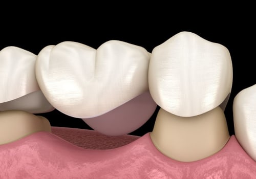 The Process for Getting a Dental Bridge: Everything You Need to Know